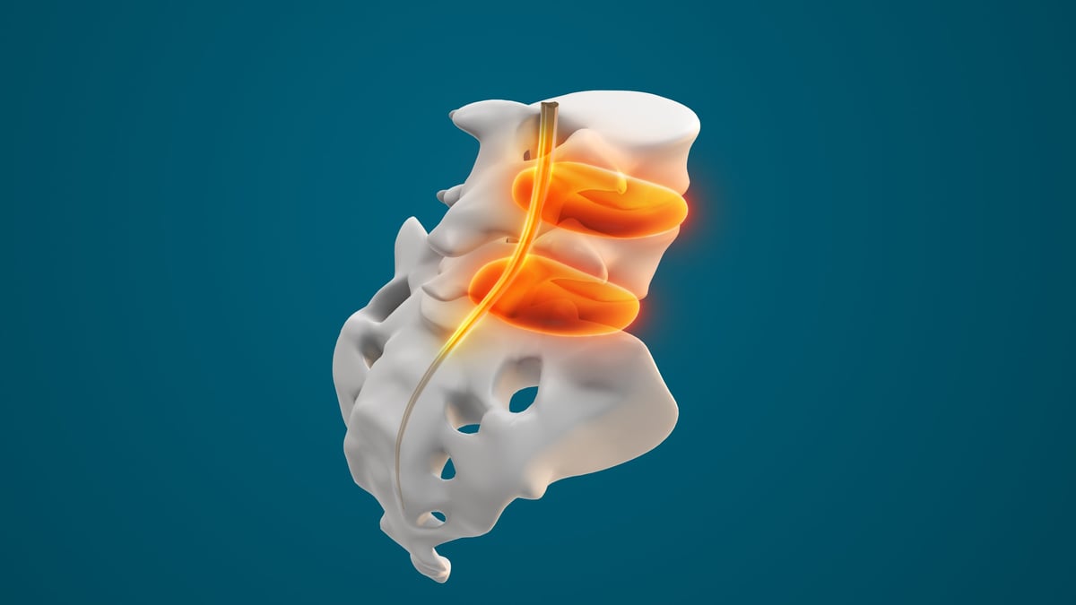 Sciatic nerve pain in the lower back occurs when the sciatic nerve becomes compressed or irritated, often due to a herniated disc or spinal degeneration. Pain typically radiates from the lumbar spine through the hips, buttocks, and down one leg, causing discomfort and limited mobility.